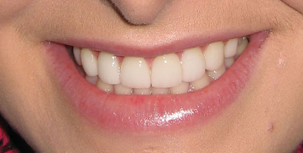 Case 1 — Porcelain Veneers — after